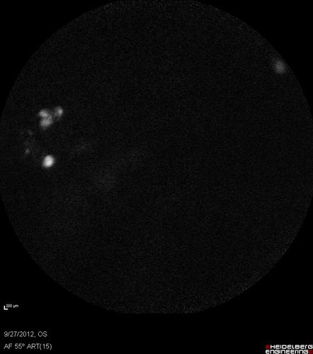 Retinitis Pigmentosa - Autosomal Dominant - Vision Loss at Young Age - Autofluorescence
 54-year-old woman has autosomal dominant retinitis pigmentosa.  Her mother and grandmother both had it and she has one son who has it and one daughter who doesnâ€™t.  She also has a sister with it.  She lost vision since she was younger.  She had cataract surgery done in January and February of this year.  She has been seeing unusual flashing lights throughout the periphery and central vision for about the last year or two.  

VISUAL ACUITY:  OD 20/160,  OS 20/160
