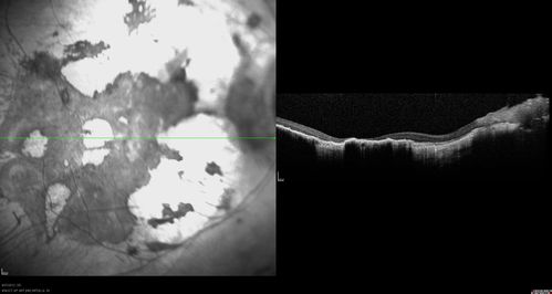 Retinitis Pigmentosa - Autosomal Dominant - Vision Loss at Young Age- SD OCT
 54-year-old woman has autosomal dominant retinitis pigmentosa.  Her mother and grandmother both had it and she has one son who has it and one daughter who doesnâ€™t.  She also has a sister with it.  She lost vision since she was younger.  She had cataract surgery done in January and February of this year.  She has been seeing unusual flashing lights throughout the periphery and central vision for about the last year or two.  

VISUAL ACUITY:  OD 20/160,  OS 20/160
