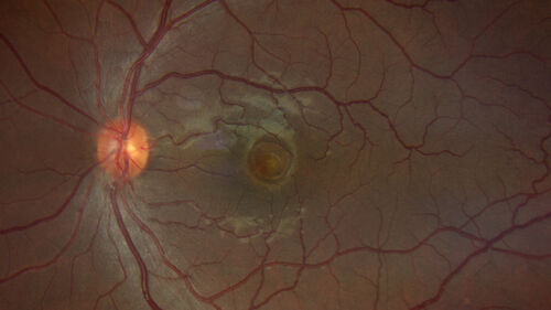 Best Disease
30 year old man vision 20/40 OD, 20/20 OS - strong family history
