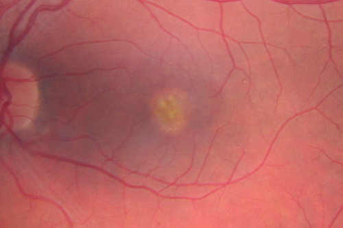 Best Disease - Color Fundus Photo
