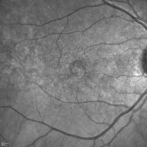 Best Disease Infra Red
