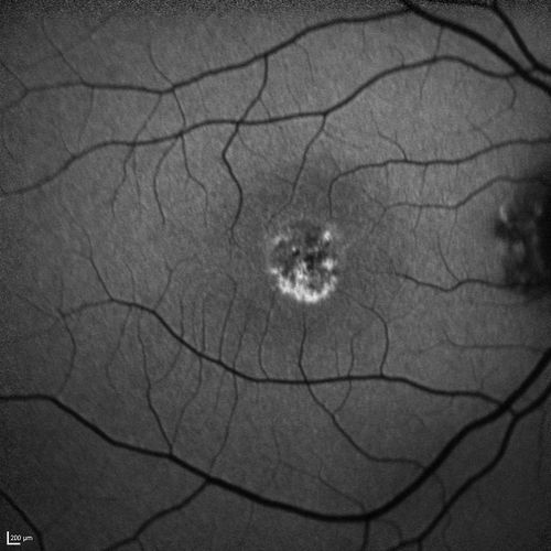 Best Disease Fundus Autofluorescence
