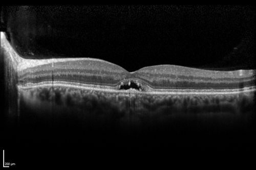 Best Disease - SD OCT Line Scan
