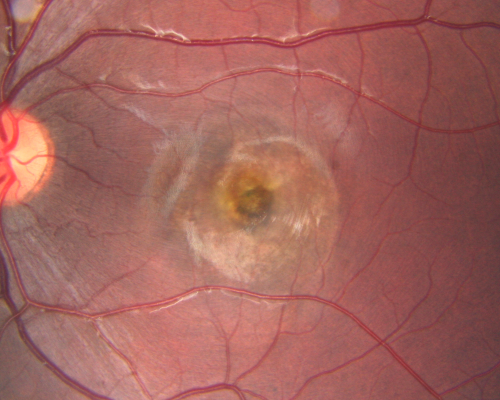 Best Disease - Left Eye Treated Previously, Elsewhere, with PDT and Avastin
11-year-old has Bestâ€™s disease that runs in his family on his mothers side. At another retina specialists office, he had photodynamic laser in April of 2009 and Avastin subsequently in June of 2009.  Unfortunately with that his vision is substantially declining.  OD 20/30,  OS 20/100
Keywords: best;dystrophy;pdt;avastin