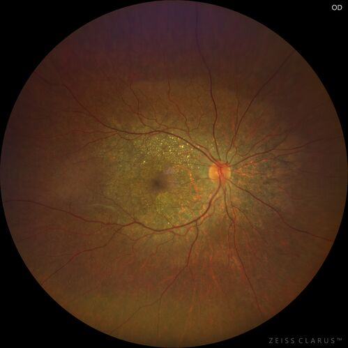 Bietti's Crystalline Dystrophy - CYP4V2 homozygous
58-year-old-female (from Thailand)
Patient had evaluation for LASIK and there was concern that the BCVA was not normal.
PMHx Benign,  Meds: none
VA 20/25 OU
