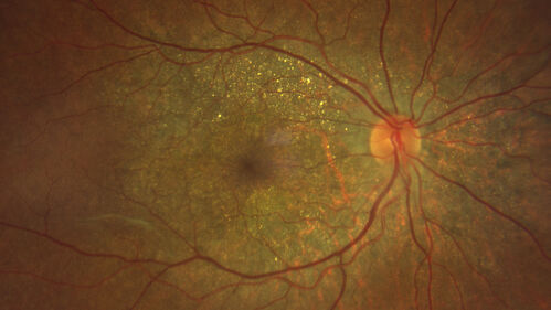 Bietti's Crystalline Dystrophy - CYP4V2 homozygous
58-year-old-female (from Thailand)
Patient had evaluation for LASIK and there was concern that the BCVA was not normal.
PMHx Benign,  Meds: none
VA 20/25 OU
