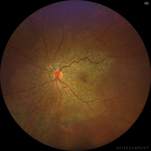 Bietti's Crystalline Dystrophy - CYP4V2 homozygous
58-year-old-female (from Thailand)
Patient had evaluation for LASIK and there was concern that the BCVA was not normal.
PMHx Benign,  Meds: none
VA 20/25 OU
