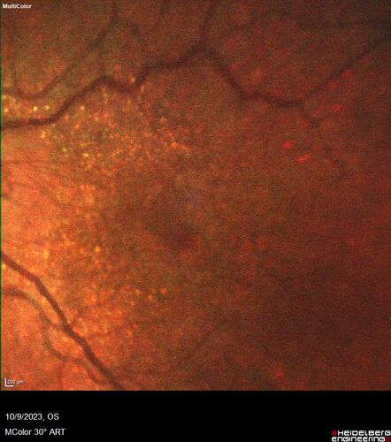 Bietti's Crystalline Dystrophy - CYP4V2 homozygous
58-year-old-female (from Thailand)
Patient had evaluation for LASIK and there was concern that the BCVA was not normal.
PMHx Benign,  Meds: none
VA 20/25 OU
