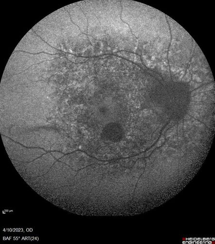 Bietti's Crystalline Dystrophy - CYP4V2 homozygous
58-year-old-female (from Thailand)
Patient had evaluation for LASIK and there was concern that the BCVA was not normal.
PMHx Benign,  Meds: none
VA 20/25 OU
