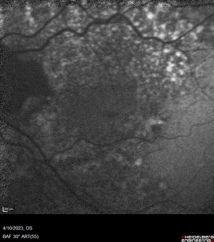 Bietti's Crystalline Dystrophy - CYP4V2 homozygous
58-year-old-female (from Thailand)
Patient had evaluation for LASIK and there was concern that the BCVA was not normal.
PMHx Benign,  Meds: none
VA 20/25 OU
