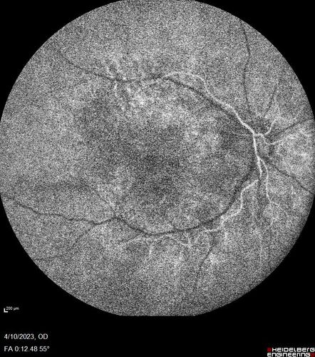 Bietti's Crystalline Dystrophy - CYP4V2 homozygous
58-year-old-female (from Thailand)
Patient had evaluation for LASIK and there was concern that the BCVA was not normal.
PMHx Benign,  Meds: none
VA 20/25 OU
