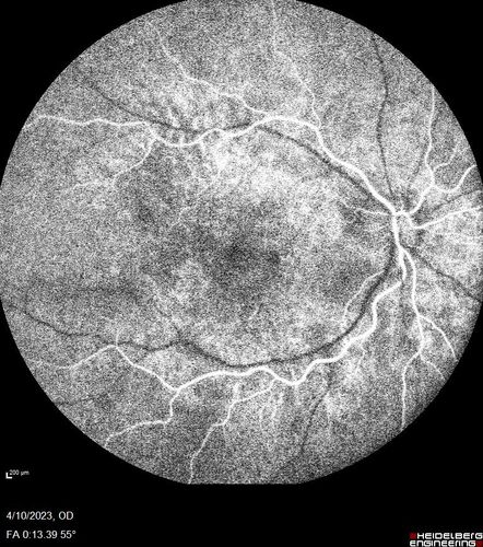 Bietti's Crystalline Dystrophy - CYP4V2 homozygous
58-year-old-female (from Thailand)
Patient had evaluation for LASIK and there was concern that the BCVA was not normal.
PMHx Benign,  Meds: none
VA 20/25 OU
