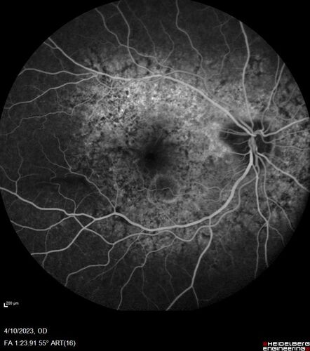 Bietti's Crystalline Dystrophy - CYP4V2 homozygous
58-year-old-female (from Thailand)
Patient had evaluation for LASIK and there was concern that the BCVA was not normal.
PMHx Benign,  Meds: none
VA 20/25 OU
