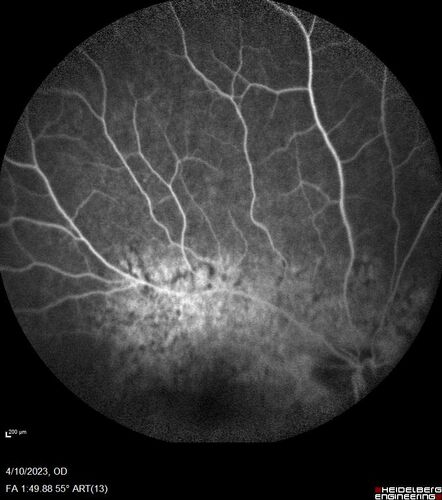 Bietti's Crystalline Dystrophy - CYP4V2 homozygous
58-year-old-female (from Thailand)
Patient had evaluation for LASIK and there was concern that the BCVA was not normal.
PMHx Benign,  Meds: none
VA 20/25 OU
