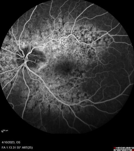 Bietti's Crystalline Dystrophy - CYP4V2 homozygous
58-year-old-female (from Thailand)
Patient had evaluation for LASIK and there was concern that the BCVA was not normal.
PMHx Benign,  Meds: none
VA 20/25 OU
