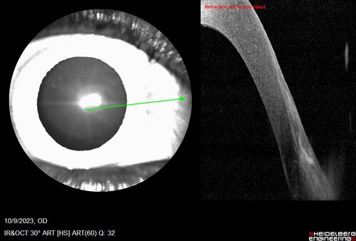 Bietti's Crystalline Dystrophy - CYP4V2 homozygous
58-year-old-female (from Thailand)
Patient had evaluation for LASIK and there was concern that the BCVA was not normal.
PMHx Benign,  Meds: none
VA 20/25 OU
