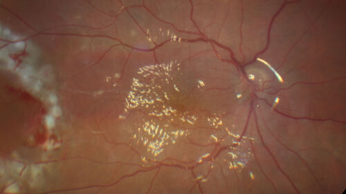 Bilateral PVR total retinal detachment in homeless man
41-year-old homeless man
Vision loss in both eyes for many months which is not getting better.
PMhx – Benign
Meds – none
VA OD: HM,  OS: 2/200
IOP 14, 15
Anterior segments: 1+ NS OU
Post-op vision at 3 months was 2/200 both eyes uncorrected (see images)
