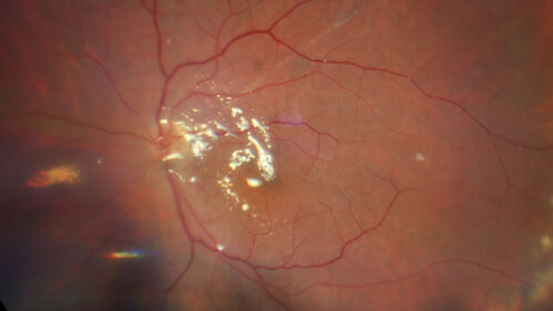 Bilateral PVR total retinal detachment in homeless man
41-year-old homeless man
Vision loss in both eyes for many months which is not getting better.
PMhx – Benign
Meds – none
VA OD: HM,  OS: 2/200
IOP 14, 15
Anterior segments: 1+ NS OU
Post-op vision at 3 months was 2/200 both eyes uncorrected (see images)

