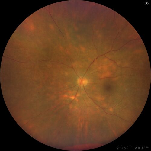 Birdshot chorioretinitis with macular edema - positive HLAA29
67 year old female with 'vitreous hemorrhage' in the right eye for a year.  Extensive uveitis work up done but now with HLA A29.  HLA A29 was positive.  She has not responded to kenalog injections (posterior) and will be started on systemic therapy soon
