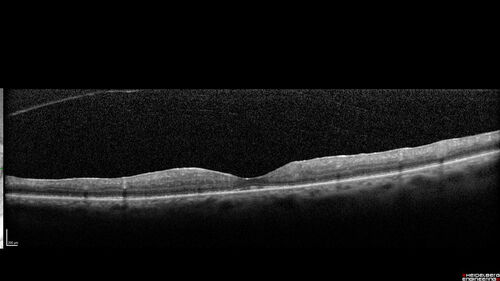 Birdshot chorioretinitis with macular edema - positive HLAA29
67 year old female with 'vitreous hemorrhage' in the right eye for a year.  Extensive uveitis work up done but now with HLA A29.  HLA A29 was positive.  She has not responded to kenalog injections (posterior) and will be started on systemic therapy soon
