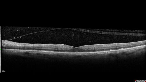 Birdshot chorioretinitis with macular edema - positive HLAA29
67 year old female with 'vitreous hemorrhage' in the right eye for a year.  Extensive uveitis work up done but now with HLA A29.  HLA A29 was positive.  She has not responded to kenalog injections (posterior) and will be started on systemic therapy soon

