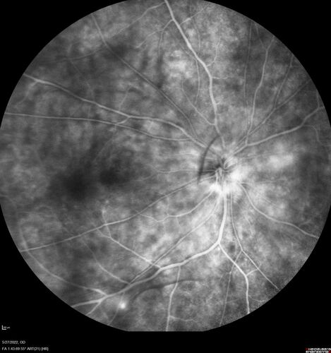 Birdshot chorioretinitis with macular edema - positive HLAA29
67 year old female with 'vitreous hemorrhage' in the right eye for a year.  Extensive uveitis work up done but now with HLA A29.  HLA A29 was positive.  She has not responded to kenalog injections (posterior) and will be started on systemic therapy soon
