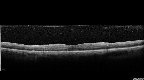 Birdshot chorioretinitis with macular edema - positive HLAA29
67 year old female with 'vitreous hemorrhage' in the right eye for a year.  Extensive uveitis work up done but now with HLA A29.  HLA A29 was positive.  She has not responded to kenalog injections (posterior) and will be started on systemic therapy soon
