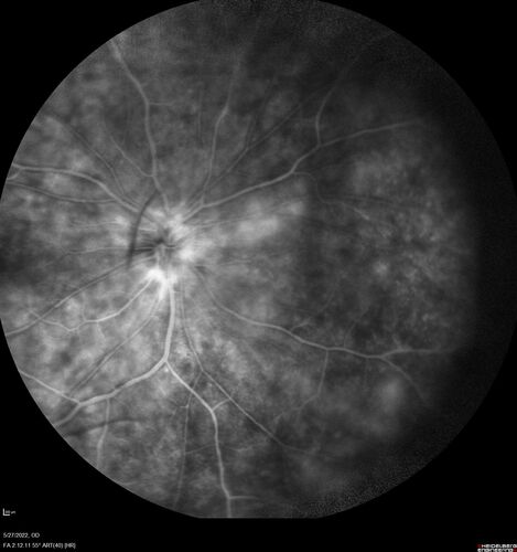 Birdshot chorioretinitis with macular edema - positive HLAA29
67 year old female with 'vitreous hemorrhage' in the right eye for a year.  Extensive uveitis work up done but now with HLA A29.  HLA A29 was positive.  She has not responded to kenalog injections (posterior) and will be started on systemic therapy soon
