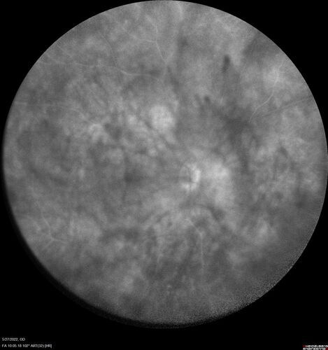 Birdshot chorioretinitis with macular edema - positive HLAA29
67 year old female with 'vitreous hemorrhage' in the right eye for a year.  Extensive uveitis work up done but now with HLA A29.  HLA A29 was positive.  She has not responded to kenalog injections (posterior) and will be started on systemic therapy soon
