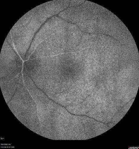 Birdshot chorioretinitis with macular edema - positive HLAA29
67 year old female with 'vitreous hemorrhage' in the right eye for a year.  Extensive uveitis work up done but now with HLA A29.  HLA A29 was positive.  She has not responded to kenalog injections (posterior) and will be started on systemic therapy soon
