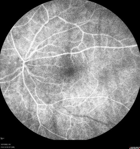Birdshot chorioretinitis with macular edema - positive HLAA29
67 year old female with 'vitreous hemorrhage' in the right eye for a year.  Extensive uveitis work up done but now with HLA A29.  HLA A29 was positive.  She has not responded to kenalog injections (posterior) and will be started on systemic therapy soon
