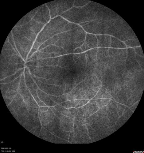 Birdshot chorioretinitis with macular edema - positive HLAA29
67 year old female with 'vitreous hemorrhage' in the right eye for a year.  Extensive uveitis work up done but now with HLA A29.  HLA A29 was positive.  She has not responded to kenalog injections (posterior) and will be started on systemic therapy soon
