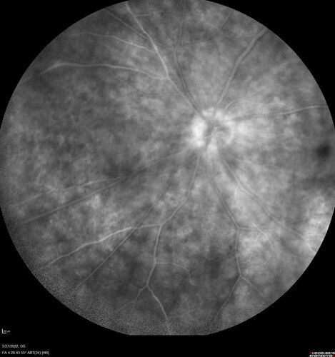 Birdshot chorioretinitis with macular edema - positive HLAA29
67 year old female with 'vitreous hemorrhage' in the right eye for a year.  Extensive uveitis work up done but now with HLA A29.  HLA A29 was positive.  She has not responded to kenalog injections (posterior) and will be started on systemic therapy soon

