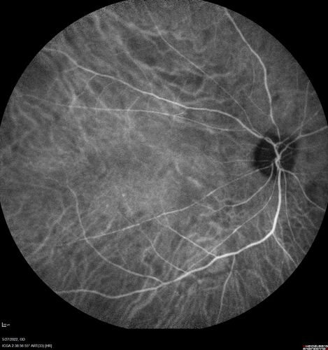Birdshot chorioretinitis with macular edema - positive HLAA29
67 year old female with 'vitreous hemorrhage' in the right eye for a year.  Extensive uveitis work up done but now with HLA A29.  HLA A29 was positive.  She has not responded to kenalog injections (posterior) and will be started on systemic therapy soon
