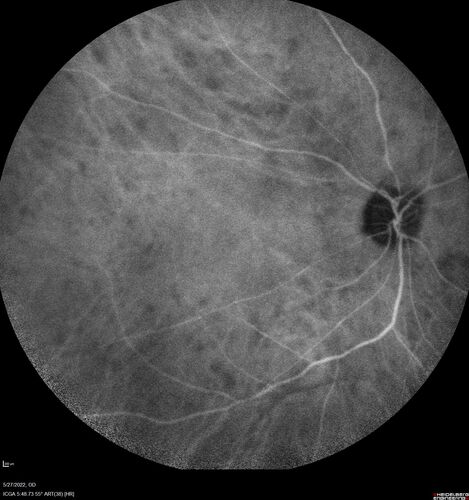 Birdshot chorioretinitis with macular edema - positive HLAA29
67 year old female with 'vitreous hemorrhage' in the right eye for a year.  Extensive uveitis work up done but now with HLA A29.  HLA A29 was positive.  She has not responded to kenalog injections (posterior) and will be started on systemic therapy soon
