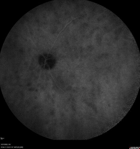 Birdshot chorioretinitis with macular edema - positive HLAA29
67 year old female with 'vitreous hemorrhage' in the right eye for a year.  Extensive uveitis work up done but now with HLA A29.  HLA A29 was positive.  She has not responded to kenalog injections (posterior) and will be started on systemic therapy soon
