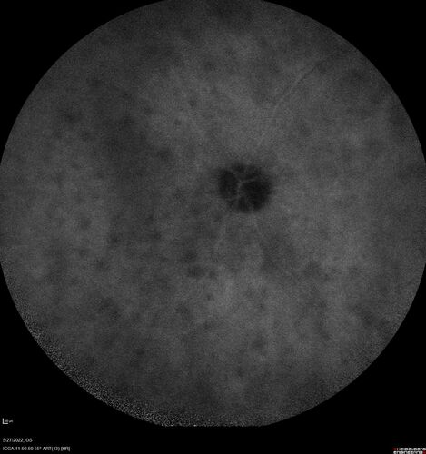 Birdshot chorioretinitis with macular edema - positive HLAA29
67 year old female with 'vitreous hemorrhage' in the right eye for a year.  Extensive uveitis work up done but now with HLA A29.  HLA A29 was positive.  She has not responded to kenalog injections (posterior) and will be started on systemic therapy soon
