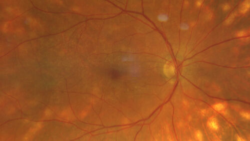 Birdshot Chorioretinitis - Chronic Untreated with Drusen Like Material in Macula
72 year old female with vision changes for years just now diagnosed with Birdshot.
