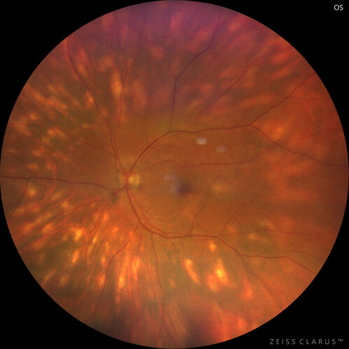 Birdshot Chorioretinitis - Chronic Untreated with Drusen Like Material in Macula
72 year old female with vision changes for years just now diagnosed with Birdshot.
