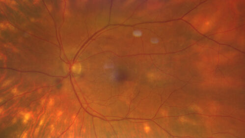 Birdshot Chorioretinitis - Chronic Untreated with Drusen Like Material in Macula
72 year old female with vision changes for years just now diagnosed with Birdshot.
