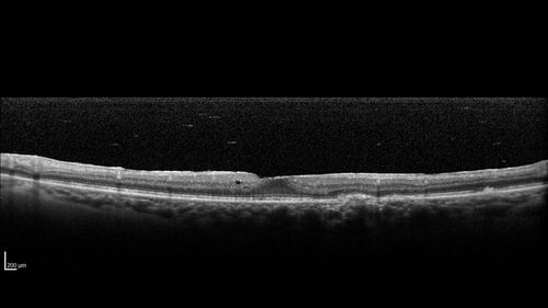 Birdshot Chorioretinitis - Chronic Untreated with Drusen Like Material in Macula
72 year old female with vision changes for years just now diagnosed with Birdshot.
