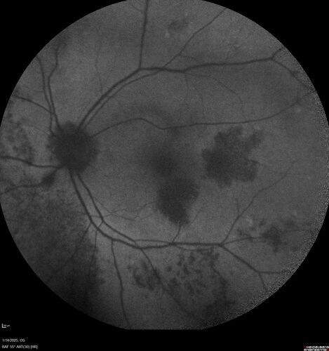 Birdshot Chorioretinitis - Chronic Untreated with Drusen Like Material in Macula
72 year old female with vision changes for years just now diagnosed with Birdshot.
