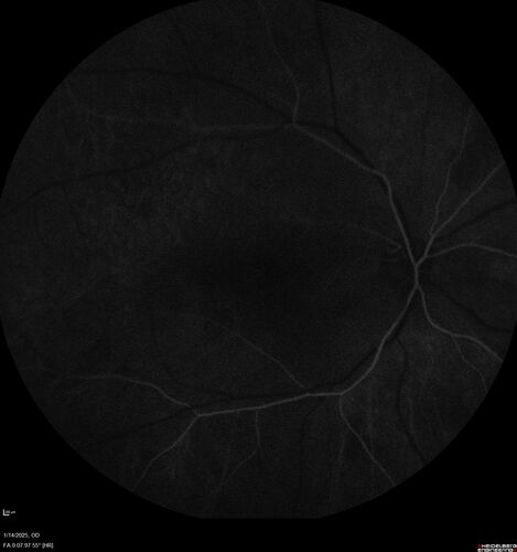 Birdshot Chorioretinitis - Chronic Untreated with Drusen Like Material in Macula
72 year old female with vision changes for years just now diagnosed with Birdshot.
