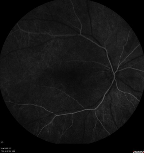 Birdshot Chorioretinitis - Chronic Untreated with Drusen Like Material in Macula
72 year old female with vision changes for years just now diagnosed with Birdshot.

