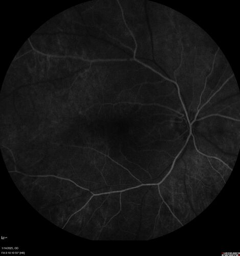 Birdshot Chorioretinitis - Chronic Untreated with Drusen Like Material in Macula
72 year old female with vision changes for years just now diagnosed with Birdshot.
