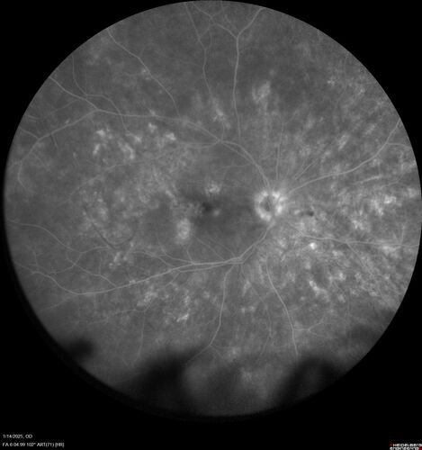Birdshot Chorioretinitis - Chronic Untreated with Drusen Like Material in Macula
72 year old female with vision changes for years just now diagnosed with Birdshot.
