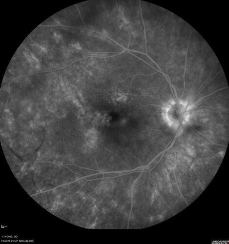 Birdshot Chorioretinitis - Chronic Untreated with Drusen Like Material in Macula
72 year old female with vision changes for years just now diagnosed with Birdshot.
