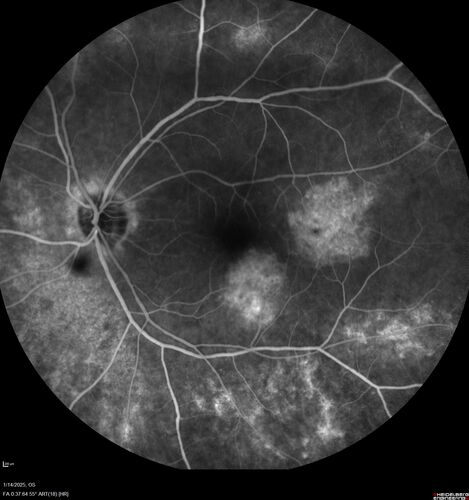 Birdshot Chorioretinitis - Chronic Untreated with Drusen Like Material in Macula
72 year old female with vision changes for years just now diagnosed with Birdshot.
