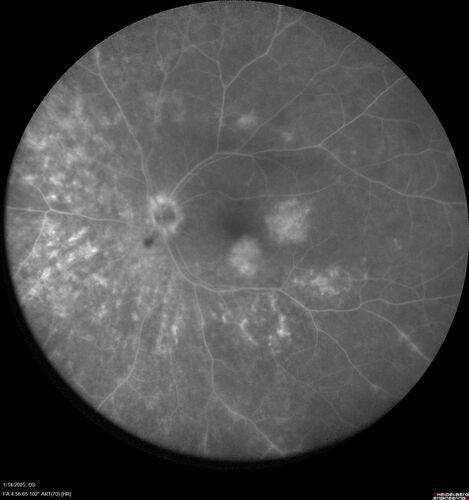 Birdshot Chorioretinitis - Chronic Untreated with Drusen Like Material in Macula
72 year old female with vision changes for years just now diagnosed with Birdshot.
