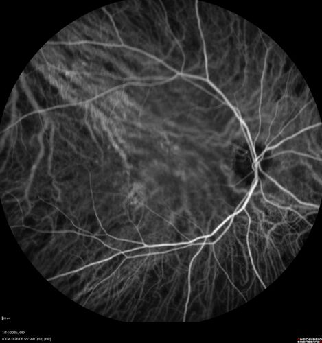 Birdshot Chorioretinitis - Chronic Untreated with Drusen Like Material in Macula
72 year old female with vision changes for years just now diagnosed with Birdshot.
